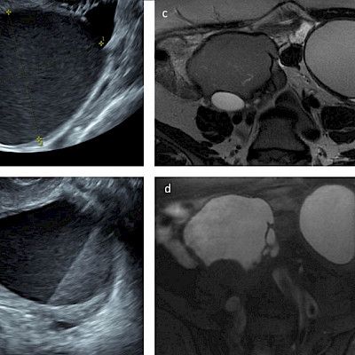 Kuvantamistutkimukset endometrioosin diagnostiikassa