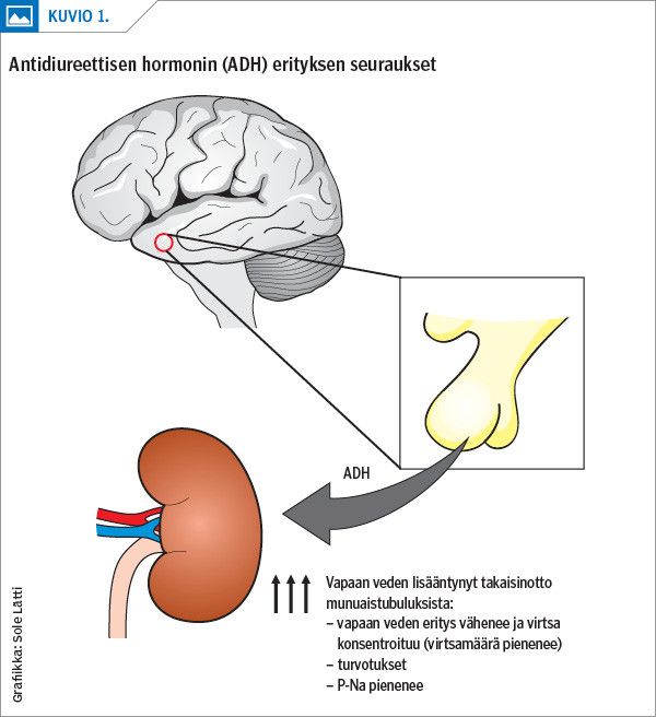 Antidiureettisen hormonin (ADH) erityksen seuraukset<p/>