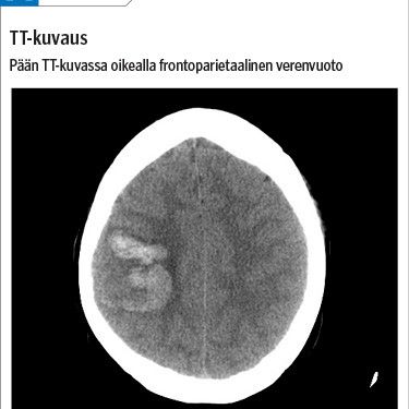 Näin tunnistat sinustromboosin