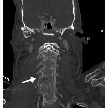 Blunt cerebrovascular injuries (BCVI): A multidisciplinary challenge