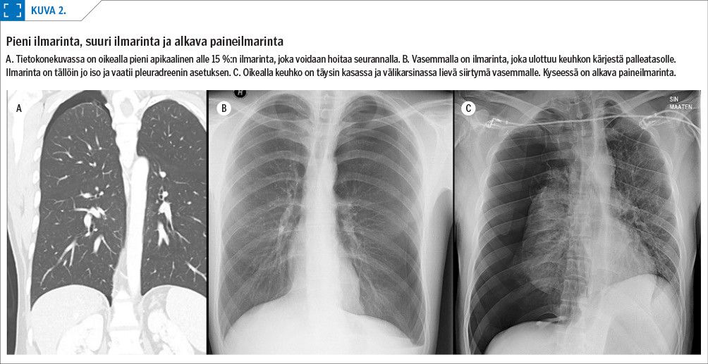 Pieni ilmarinta, suuri ilmarinta ja alkava paineilmarinta