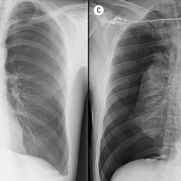 Diagnosis and treatment of spontaneous pneumothorax
