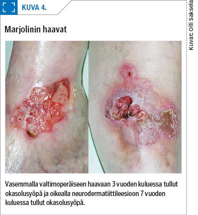 Marjolinin haavat