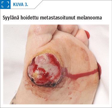 Syylänä hoidettu metastasoitunut melanooma
