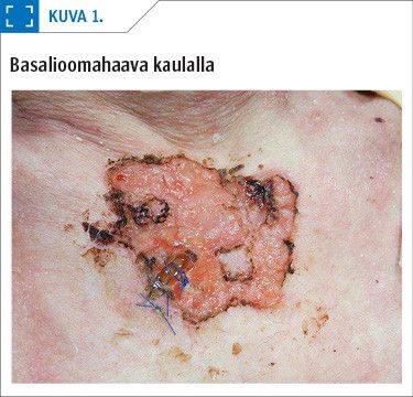 Basalioomahaava kaulalla