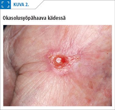 Okasolusyöpähaava kädessä