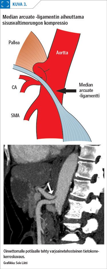 Median arcuate -ligamentin aiheuttama sisusvaltimorungon kompressio