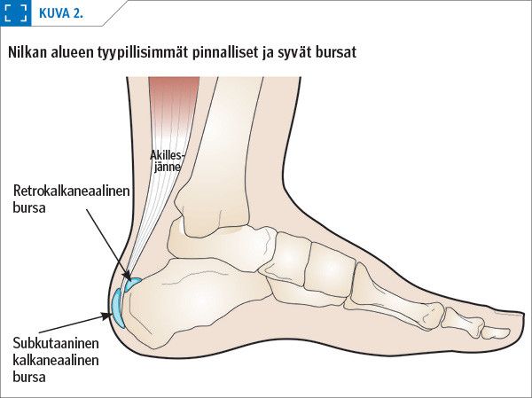 Nilkan alueen tyypillisimmät pinnalliset ja syvät bursat