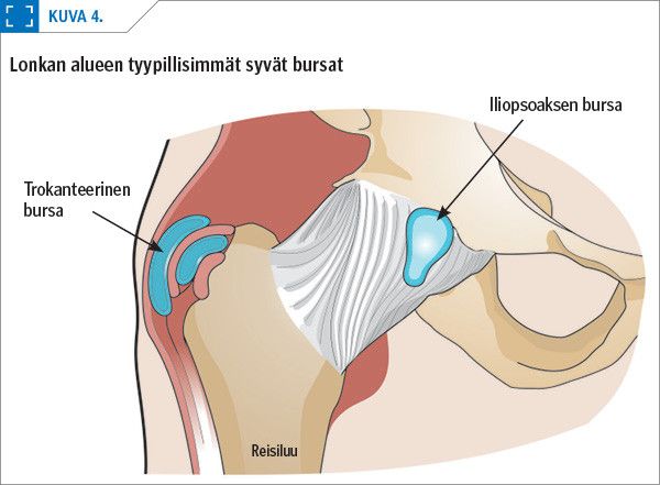 Lonkan alueen tyypillisimmät syvät bursat