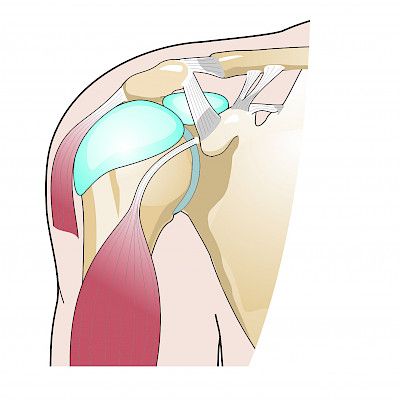 Diagnosis and treatment of bursitis