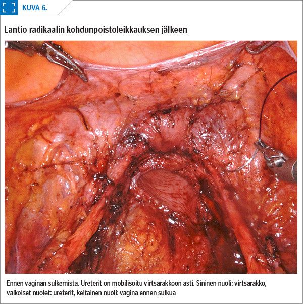 Lantio radikaalin kohdunpoistoleikkauksen jälkeen<p/>