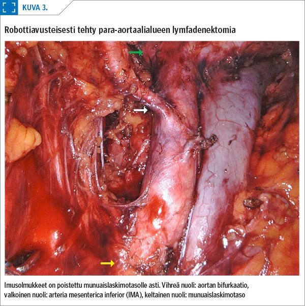 Robottiavusteisesti tehty para-aortaalialueen lymfadenektomia<p/>