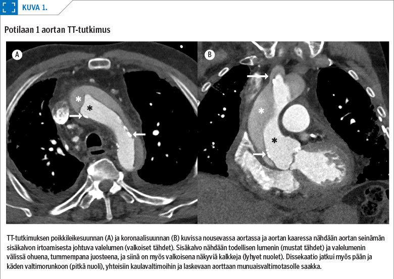Potilaan 1 aortan TT-tutkimus