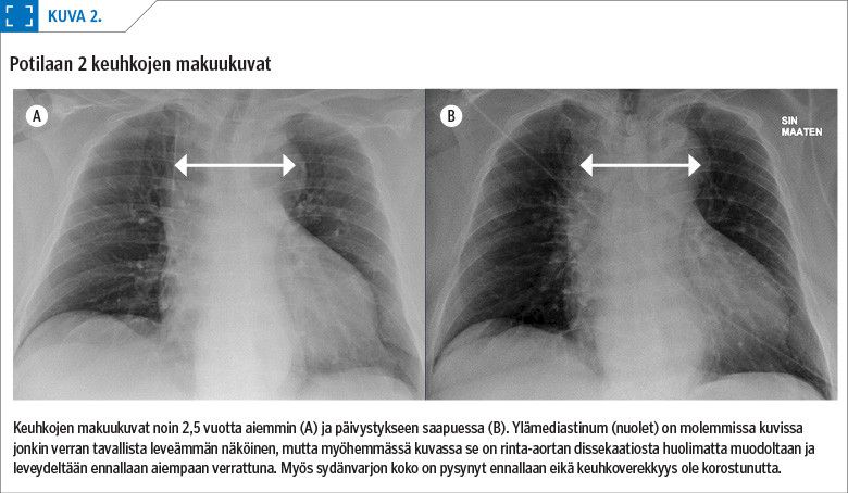 Potilaan 2 keuhkojen makuukuvat