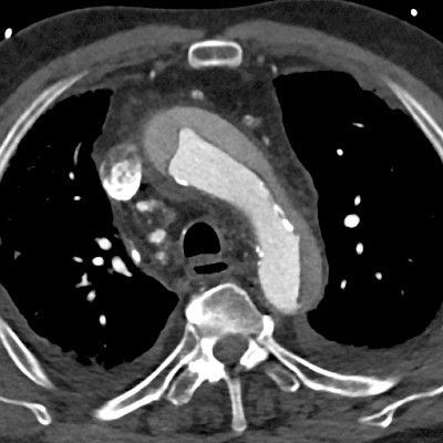 Aortic dissection – the black swan in emergency services