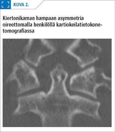 Kiertonikaman hampaan asymmetria oireettomalla henkilöllä kartiokeilatietokone­tomografiassa