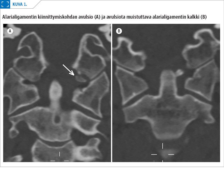 Alarialigamentin kiinnittymiskohdan avulsio (A) ja avulsiota muistuttava alarialigamentin kalkki (B)