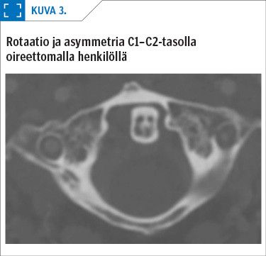 Rotaatio ja asymmetria C1–C2-tasolla ­oireettomalla henkilöllä