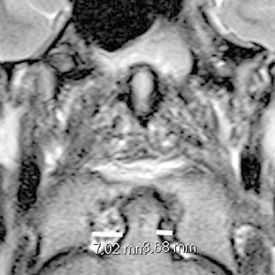 Imaging and treatment of whiplash injury