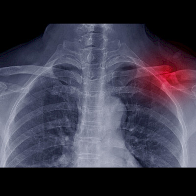 The treatment of midshaft clavicle fractures in the 2020s
– from decision by the orthopaedist to joint decision making