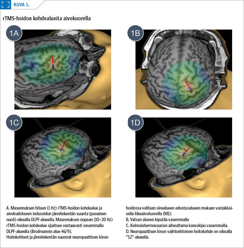 rTMS-hoidon kohdealueita aivokuorella