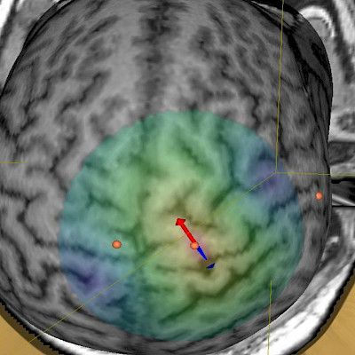 Sarjamagneettistimulaatio kivun ja neurologisten sairauksien hoidossa