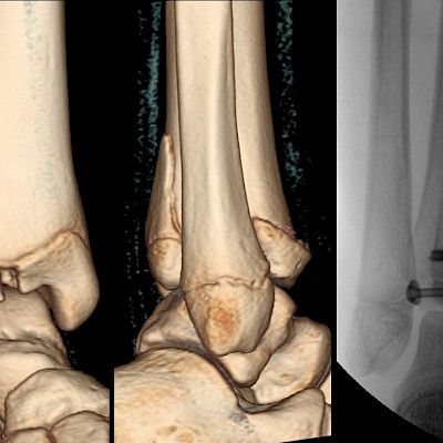 Children’s fractures and their treatment