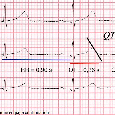 Psychiatric medication for a child or adolescent - when to examine an ECG?