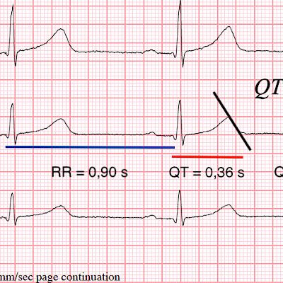 Lapselle tai nuorelle psyykenlääkitys – milloin tutkitaan EKG?