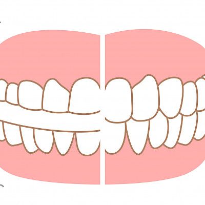 Sleep and awake bruxism and psychological distress in dental students