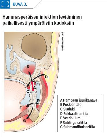 Hammasperäisen infektion leviäminen paikallisesti ympäröiviin kudoksiin<p/>