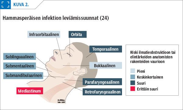 Hammasperäisen infektion leviämissuunnat (24)
