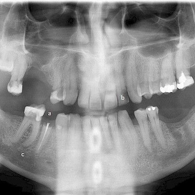 Poski turvoksissa, suu ei aukea: akuutit hammasperäiset infektiot