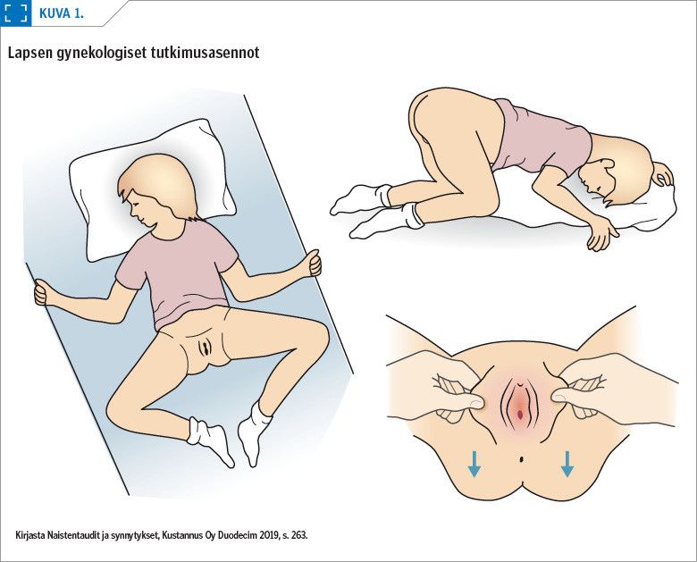 Lapsen gynekologiset tutkimusasennot<p/>