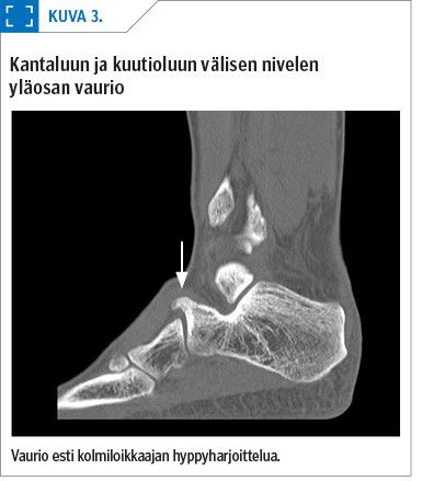 Kantaluun ja kuutioluun välisen nivelen ­yläosan vaurio