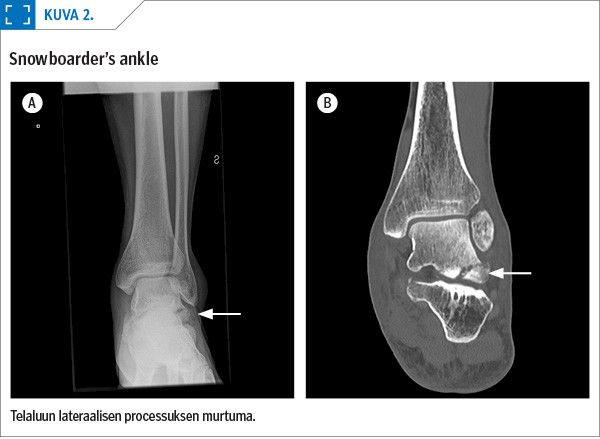 Snowboarder’s ankle