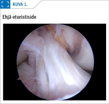 Ehjä eturistiside