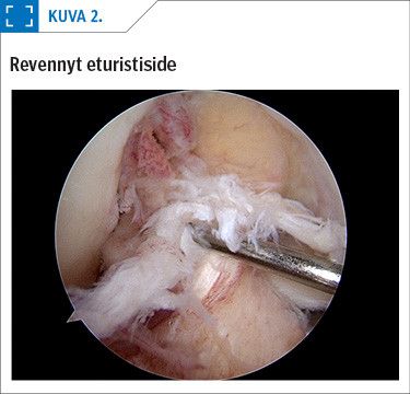 Revennyt eturistiside