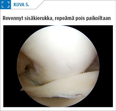 Revennyt sisäkierukka, repeämä pois paikoiltaan