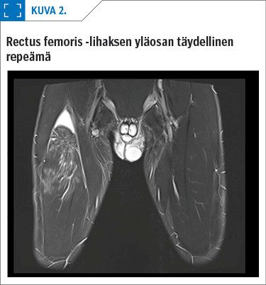 Rectus femoris -lihaksen yläosan täydellinen repeämä