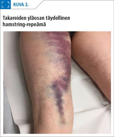 Takareiden yläosan täydellinen ­hamstring-repeämä