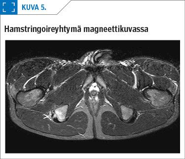 Hamstringoireyhtymä magneettikuvassa<p/>