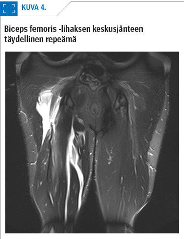 Biceps femoris -lihaksen keskusjänteen täydellinen repeämä