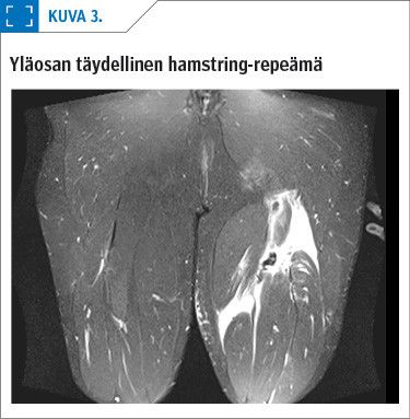 Yläosan täydellinen hamstring-repeämä