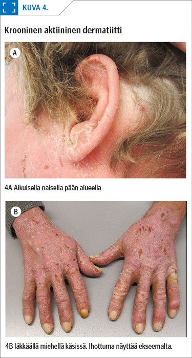 Krooninen aktiininen dermatiitti
