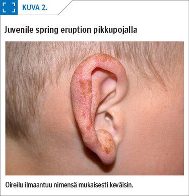 Juvenile spring eruption pikkupojalla