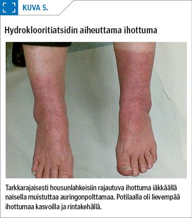 Hydroklooritiatsidin aiheuttama ihottuma