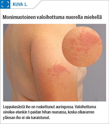 Monimuotoinen valoihottuma nuorella miehellä