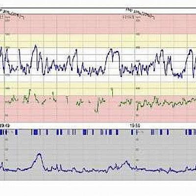 Intrapartum cardiotocography – the aspect of fetal physiology
