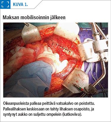 Maksan mobilisoinnin jälkeen